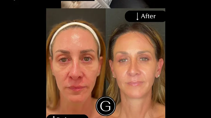 Chemical peel for Denver Botox: GATTONI Medical Aesthetics