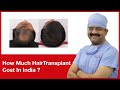 How much hair transplant cost in india  hairmd pune