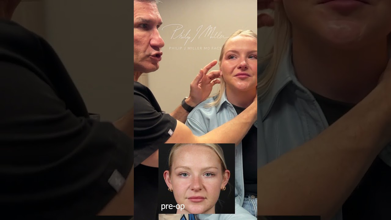 Otoplasty! 1 week post op!