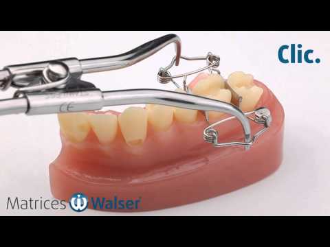 Walser® Matrices Sectionnelles: Utilisation forme O de matrice pour dent