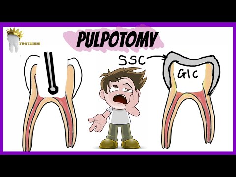 Video: Pulpotomy: Procedure, Hvad Man Kan Forvente Og Bedring