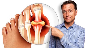 Remedy for Gout and Uric Acid - Straight From the Garden