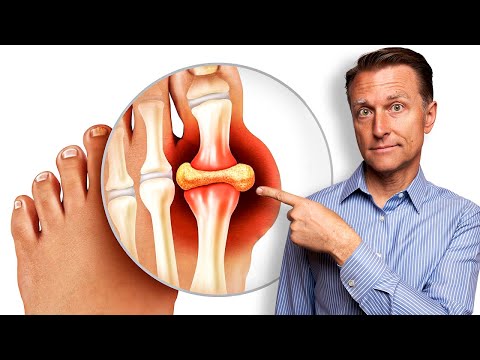 Remedy for Gout