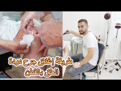 سؤال كيف يمكن اغلاق مكان عضة دودة العلق لوقف سيلان الدم