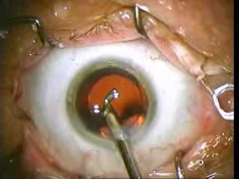 lens cataract implant surgery clip