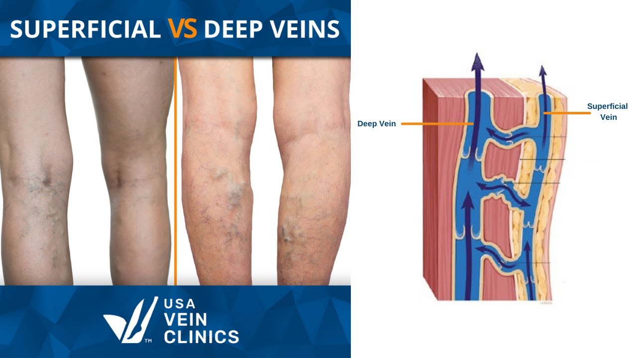 Do Varicose Veins Go Away On Their Own?