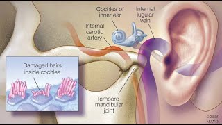 Salicylism tinnitus Or Aspirin Salicylate Toxicity to Ears