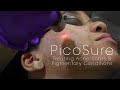 PicoSure Laser for Acne Scars & Pigmentation