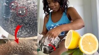 GET RID OF EXTREME DANDRUFF & DRY ITCHY SCALP | Step by Step Process Using Lemon 