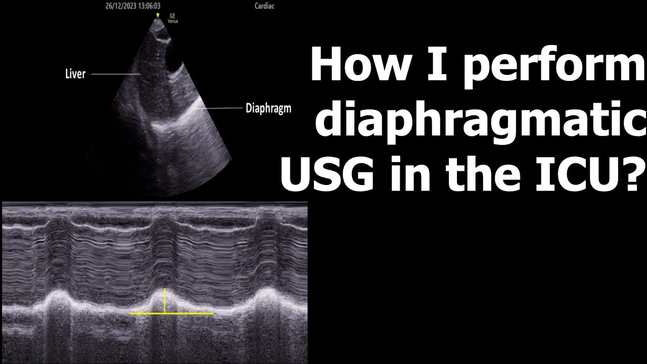 How I perform diaphragmatic USG in the ICU?
