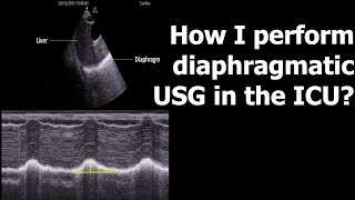 Information How I perform diaphragmatic USG in the ICU News