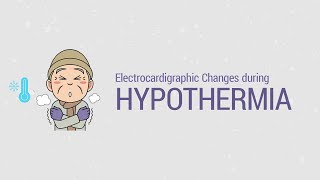 ECG changes in Hypothermia - What are the 'Osborn waves' or 'J waves'?