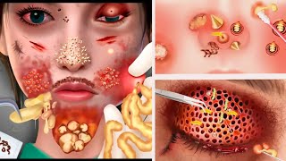 ASMR Remove Big Acne \& Maggot Infected Face | Severely Injured Animations