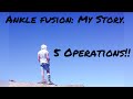 Ankle Fusion: MY STORY!