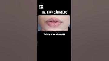 Chỉnh nha sớm ở trẻ nhỏ, khớp cắn ngược hiệu quả tại nha khoa Vinalign