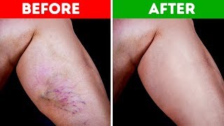 10 Natural Ways to Get Rid of Varicose Veins and Increase Blood Flow screenshot 5