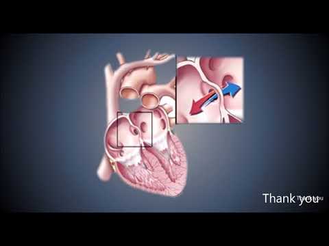 Video: Kecacatan Septum Atrium - Gejala, Rawatan, Bentuk, Peringkat, Diagnosis