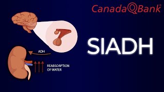 SIADH (Syndrome of Inappropriate Antidiuretic Hormone Secretion)