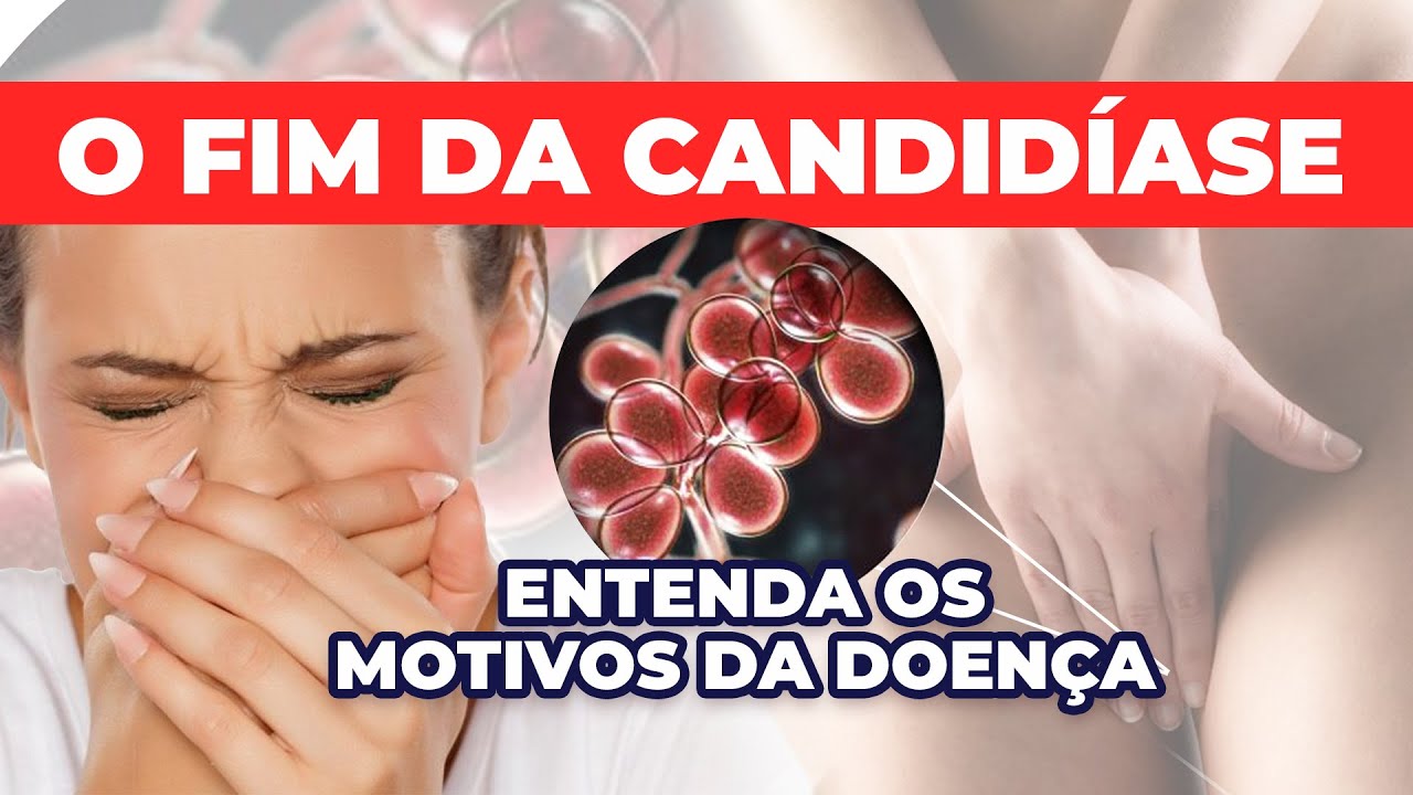 COMO ACABAR COM A CANDIDÍASE, HERPES, COCEIRA E INFECÇÃO URINÁRIA - YouTube