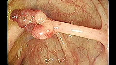 Cắt polyp có cuống đại tràng