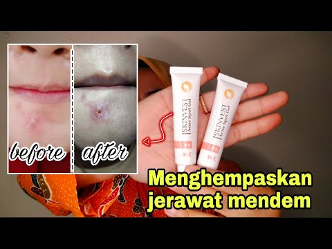 REKOMENDASI OBAT TOTOL JERAWAT, UNTUK JERAWAT MENDEM 