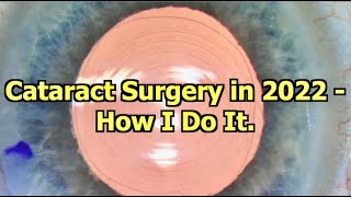 Cataract Surgery in 2022 How I Do It. - YouTube