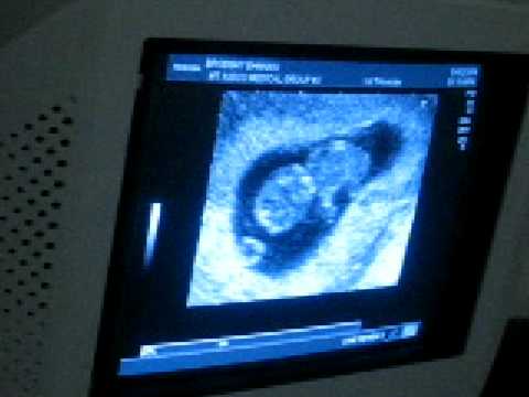 9 weeks 4 days Ultrasound - YouTube