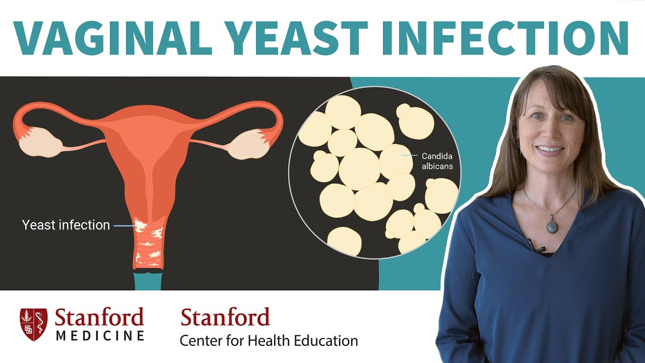 Vaginal yeast infection: Doctor explains causes, symptoms, & treatment