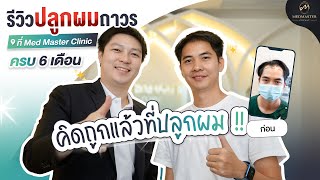 คิดถูกแล้วที่ปลูกผม!! รีวิวผลลัพธ์หลังปลูกผมถาวรครบ 6 เดือน