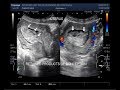 Ultrasound showing retained products of conception inside the uterine cavity