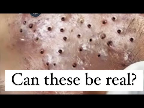 Blackhead Extraction - Professional Demonstration