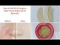 Get rid of large or open pores really fast | Get smooth fairer skin
