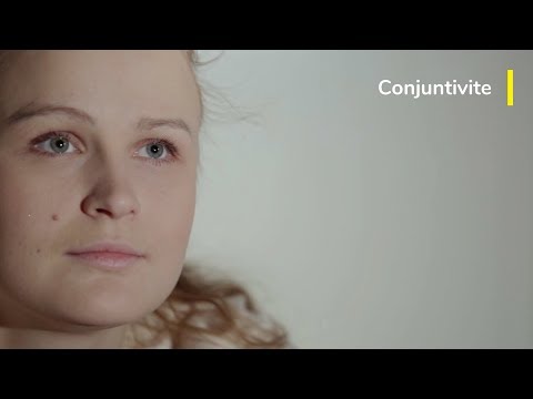 Vídeo: Ceratoconjuntivite: Tipos, Causas, Sintomas E Tratamentos