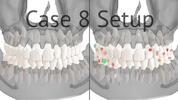 Maestro 3D aligners virtual setup: case 8, class 1 crowding, rotations with auxiliaries