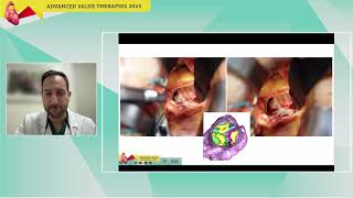 N. Spilias | TAVR optimization with AI and the role of simulations