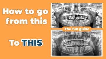 A FREE Orthodontic Guide - Class I & Impacted 11 - by @csorthoschool