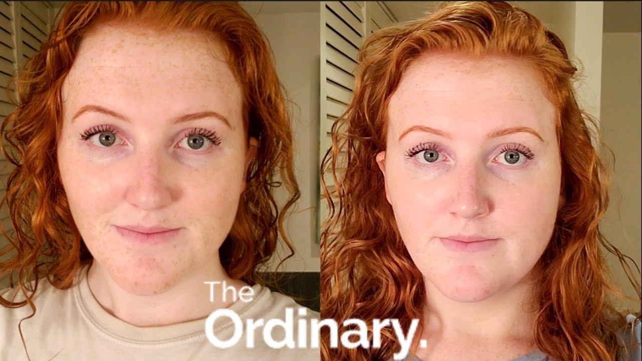 30 Days of only using The Ordinary Skincare Before & After Results