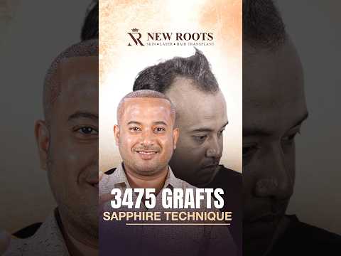 From Bahrain to Bangladesh: His Hair Transplant Journey Begins | Grade 3 Baldness | Bangla #shorts