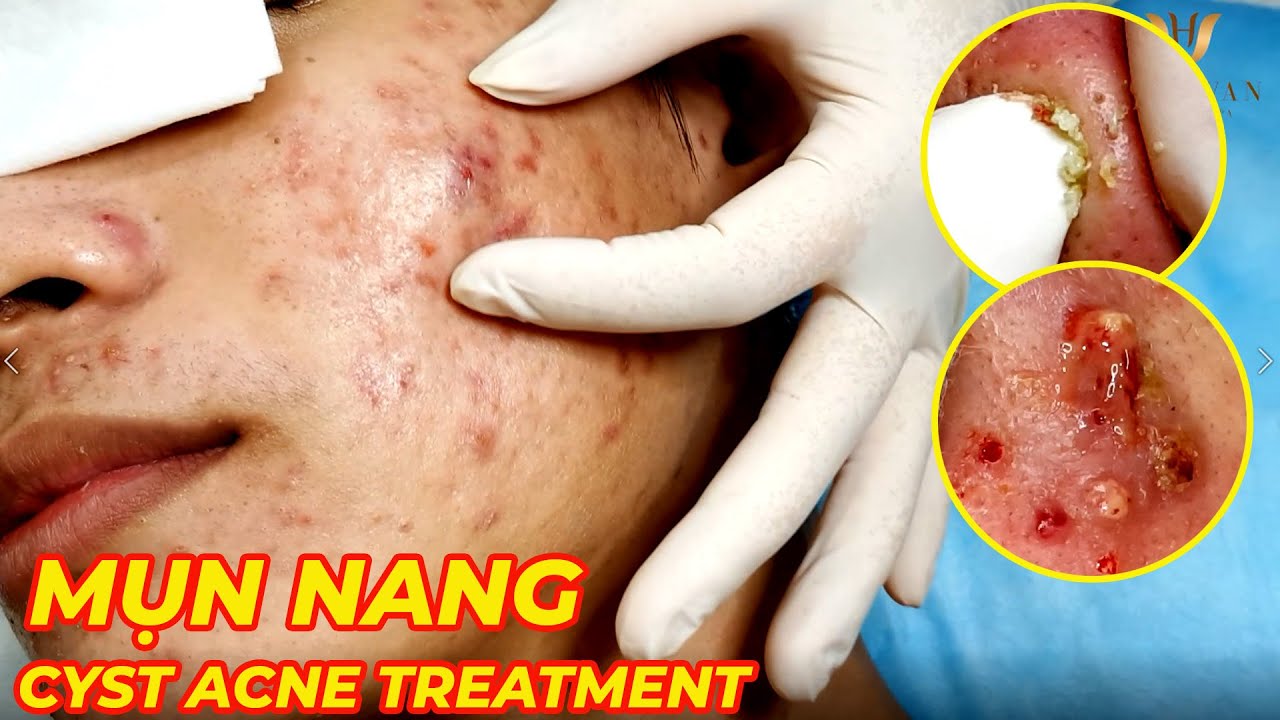 Điều trị mụn hiệu quả tại TPHCM | Hiền Vân spa | Mụn bọc, mụn mủ, mụn nang | Acne Treatment| 682