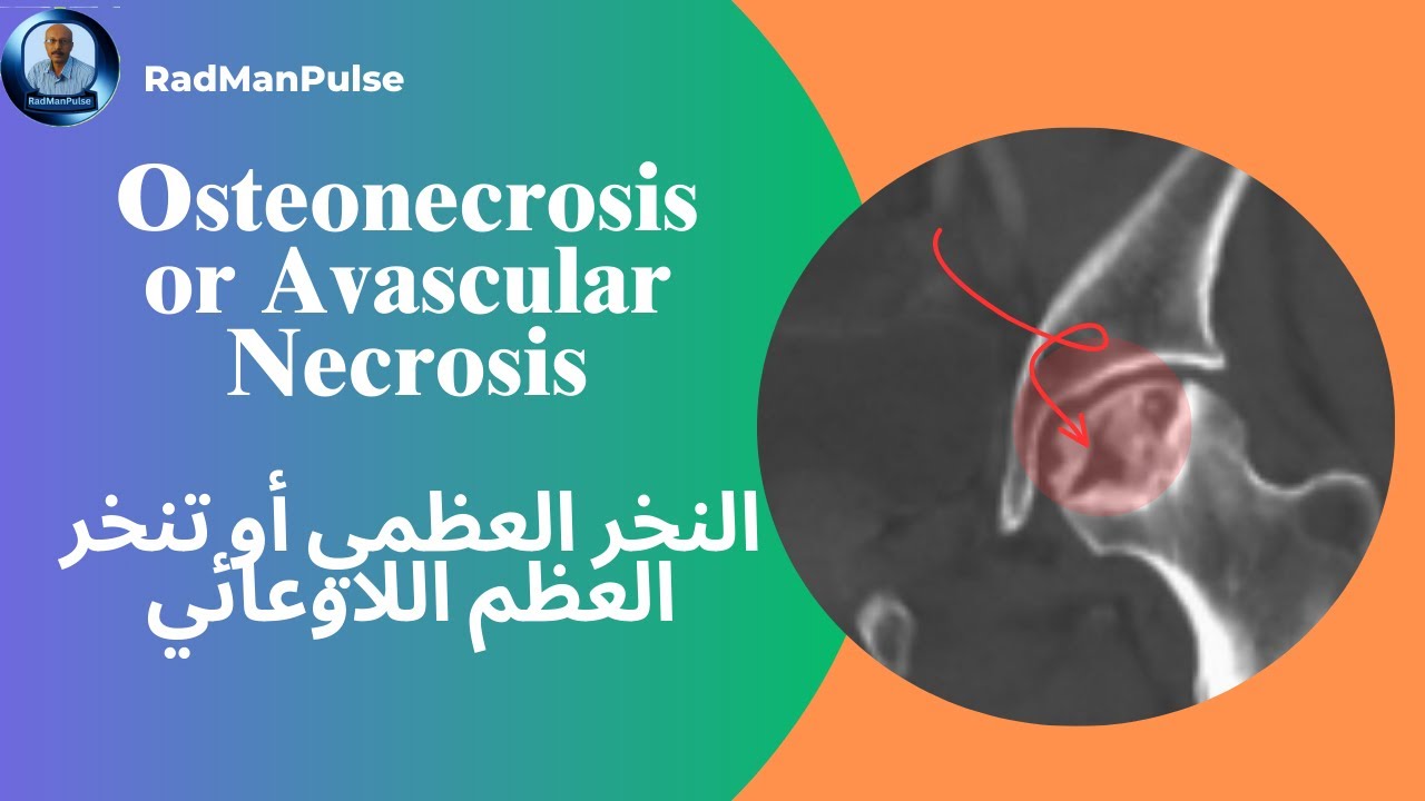 النخر العظمي في 3 دقائق فقط  Avascular Necrosis Explained in 3 Minutes