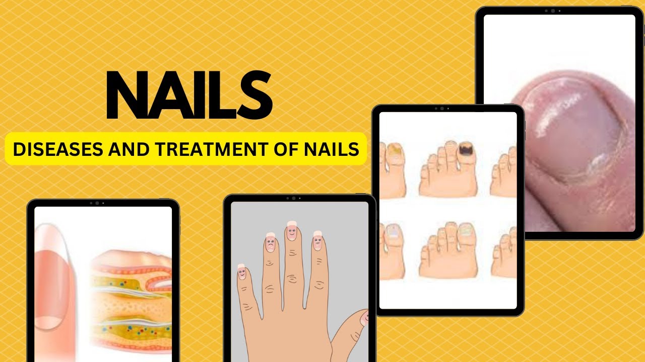 Nail diseases,Causes, Symptoms,Treatment, Prevention,Nail Fungus and it's indications