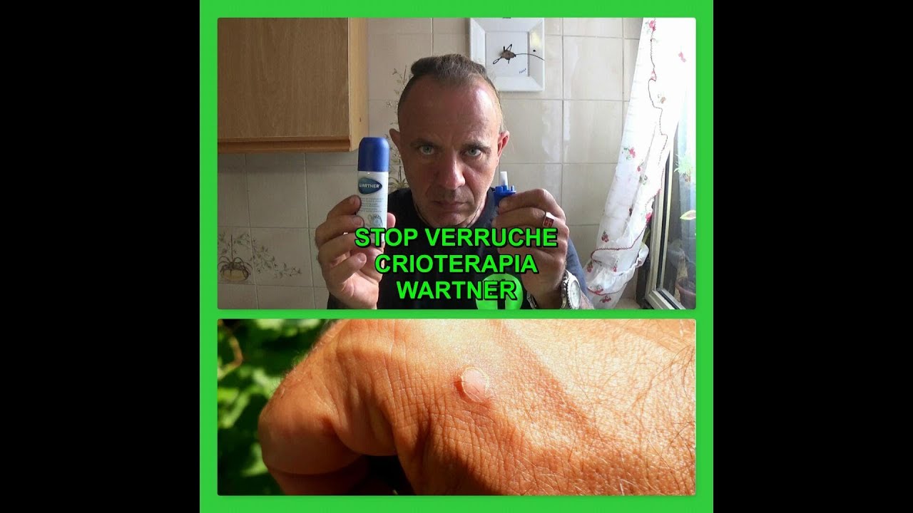 azoto liquido e verruche Asportazione verruche - Studio Medico Serini main image 1