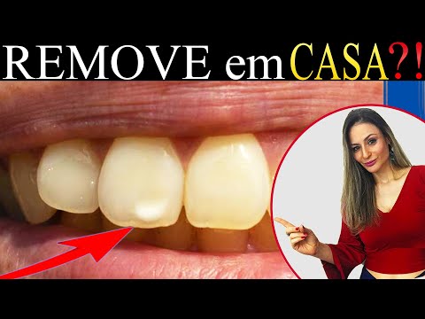 Vídeo: 3 maneiras de se livrar de manchas brancas nos dentes
