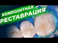 Лечение кариеса. Композитная реставрация