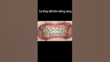 Sự thay đổi trước và sau khi niềng răng hô