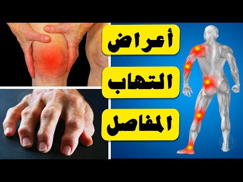 أعراض التهاب المفاصل الروماتويدي