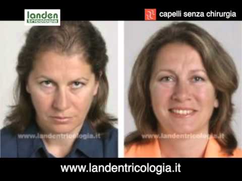 Landen tricologia - Epitesi tricologiche - YouTube