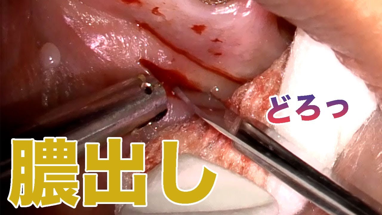 閲覧注意 膿出しで歯茎の治療処置 Youtube