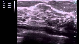 Гипоэхогенная паренхима молочных желез лучевая нагрузка(, 2014-10-03T18:59:36.000Z)