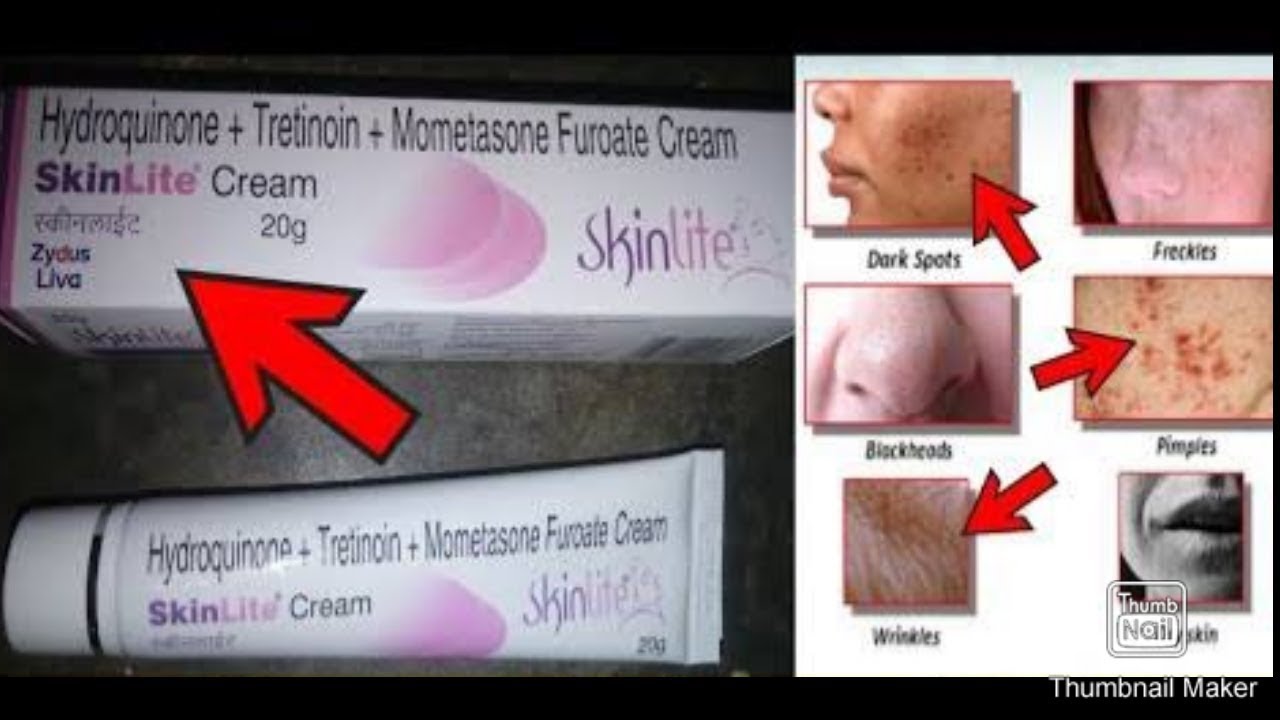 Skinlite cream review,whitening cream,remove dark spots
